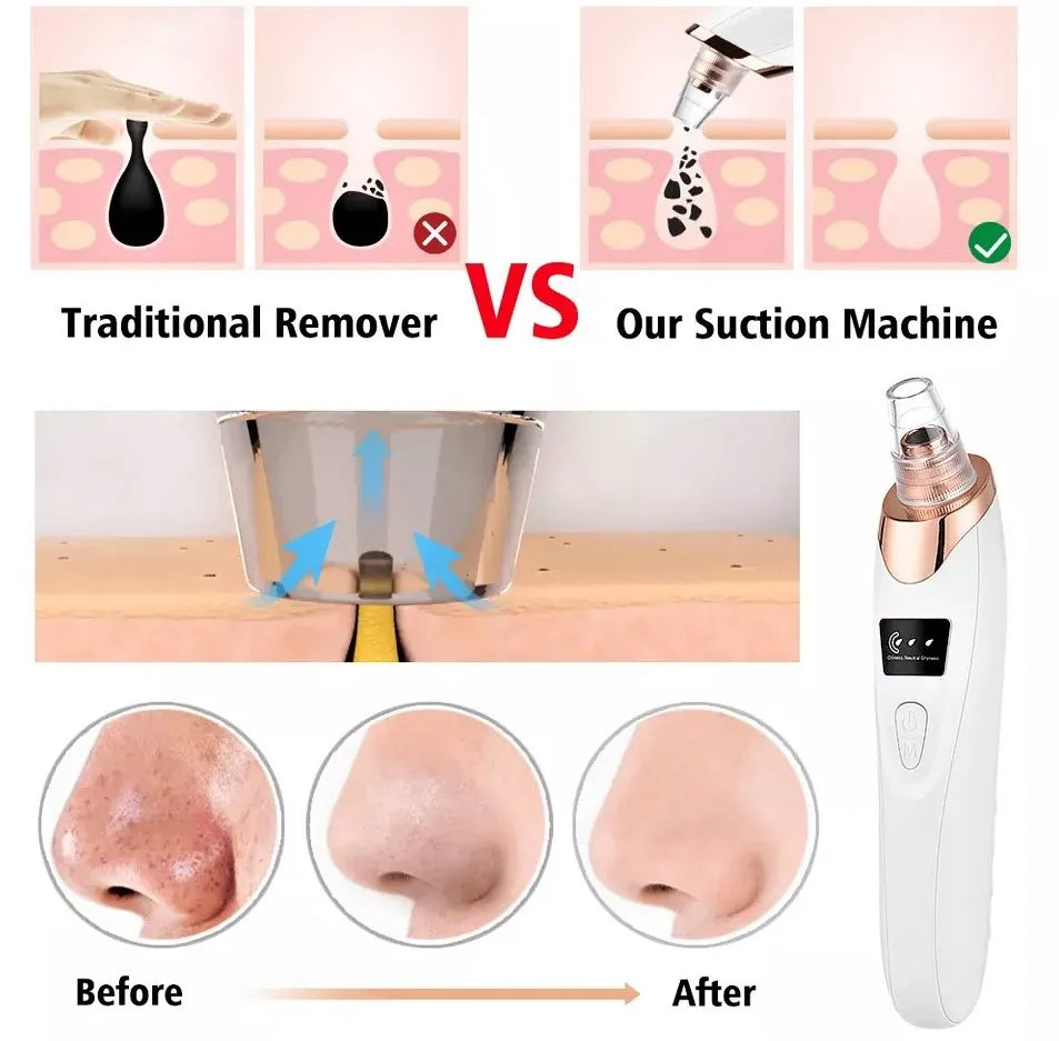 5-in-1 Rechargeable Blackhead Remover Machine – Facial Vacuum Pore Cleaner